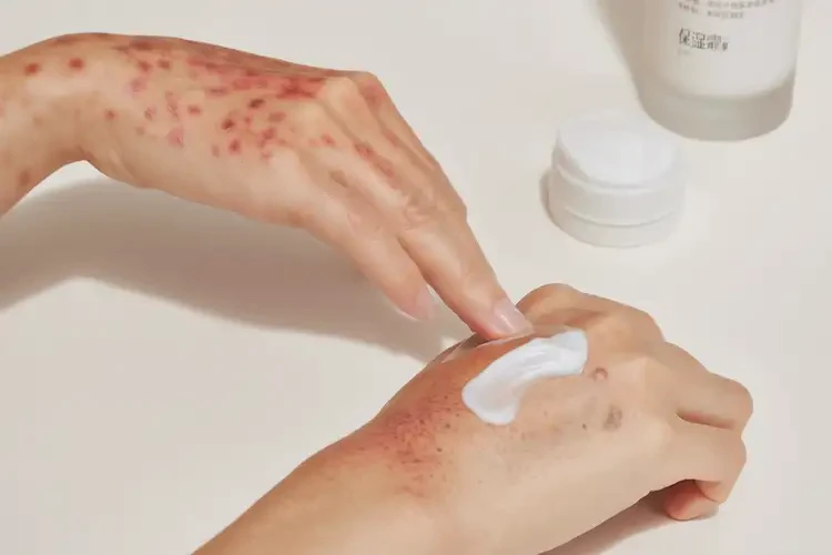 男生手上经常长湿疹可不可以根治(图3)