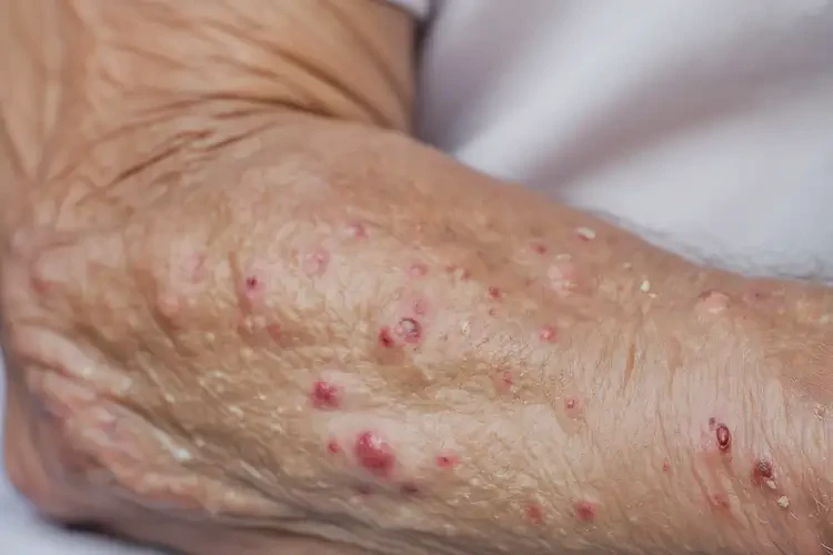 高齡老人手臂上經(jīng)常起濕疹能不能根治(圖4)