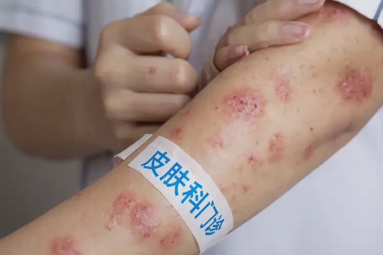 青少年手臂上長(zhǎng)濕疹不管它會(huì)自己好嗎(圖4)