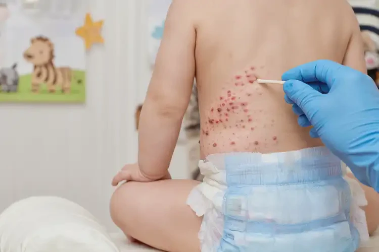 幼儿屁股上容易起湿疹能彻底自愈吗(图4)