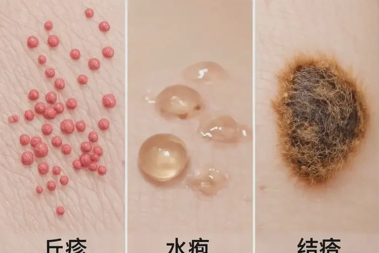 新生兒肚子起濕疹能徹底自愈嗎(圖1)