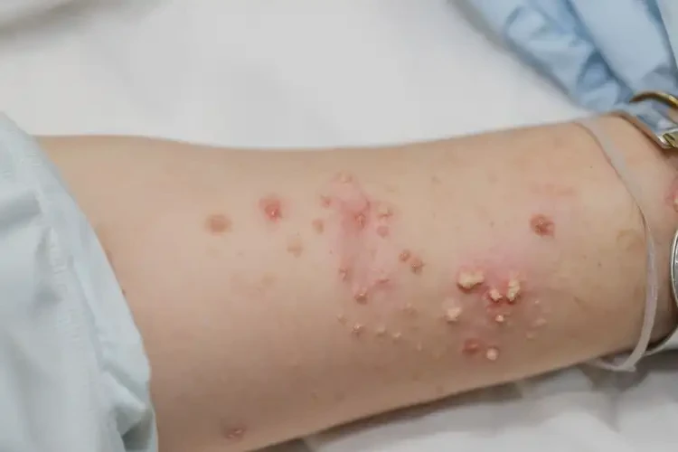 產(chǎn)婦手臂上經(jīng)常長(zhǎng)濕疹可不可以根治(圖4)