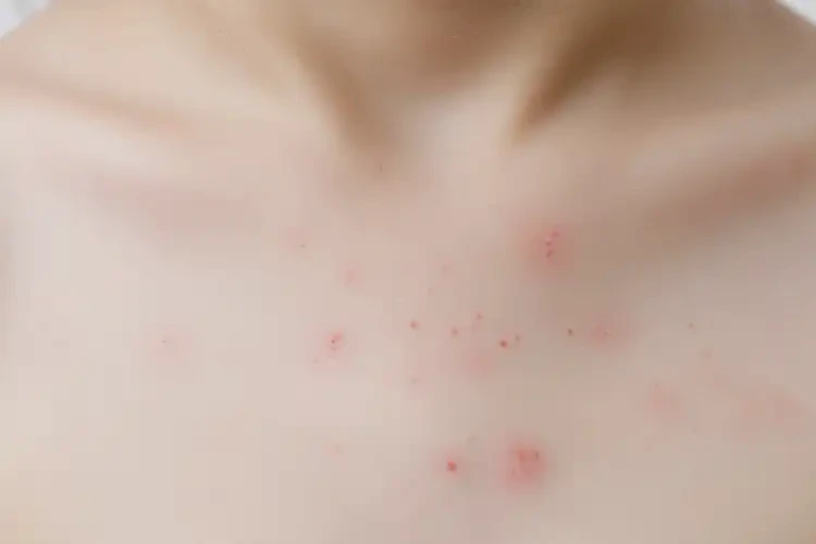 孩子脖子经常起湿疹可不可以根治(图4)