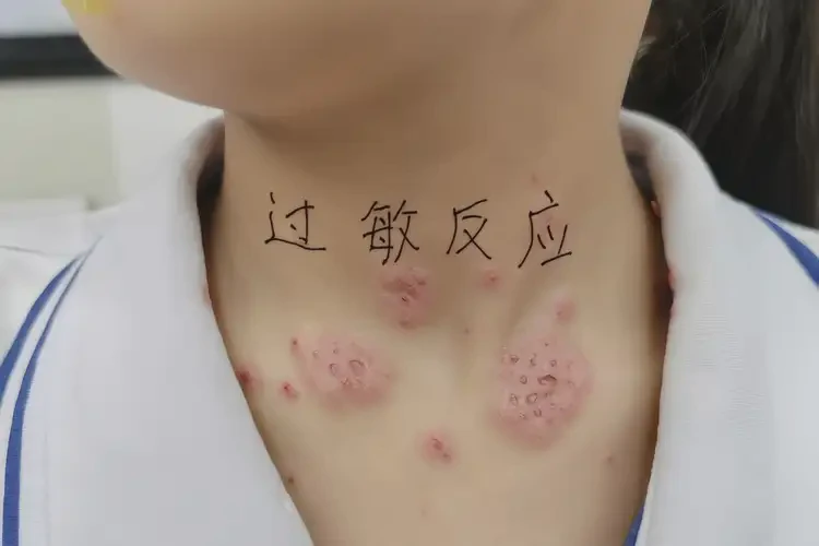 中學生脖子偶爾長濕疹可不可以根治(圖4)