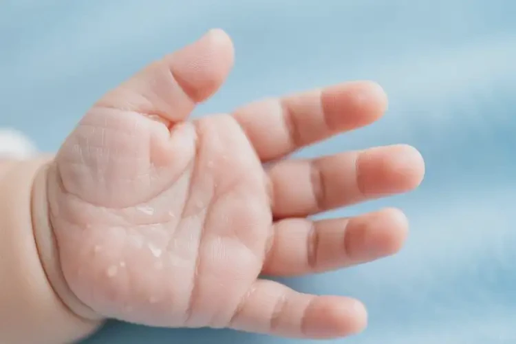 嬰兒手上起濕疹可不可以根治(圖2)