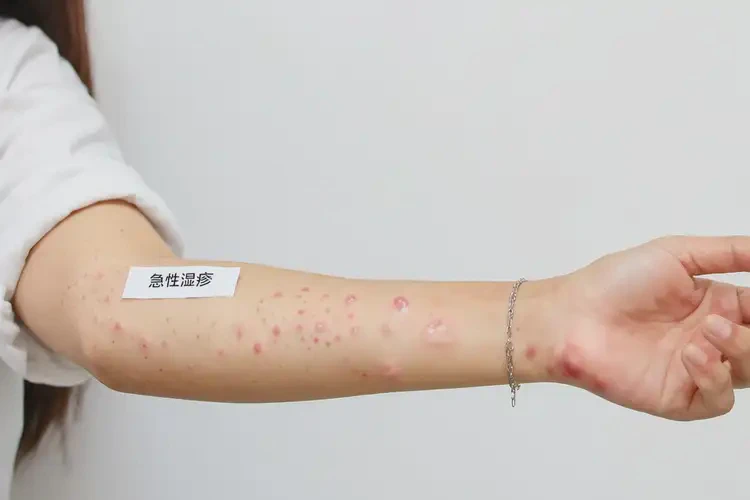女生四肢出現(xiàn)濕疹能靠自己自愈嗎(圖4)