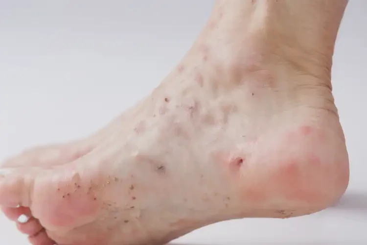 女人腳上偶爾起濕疹不管它會自己自愈嗎(圖4)