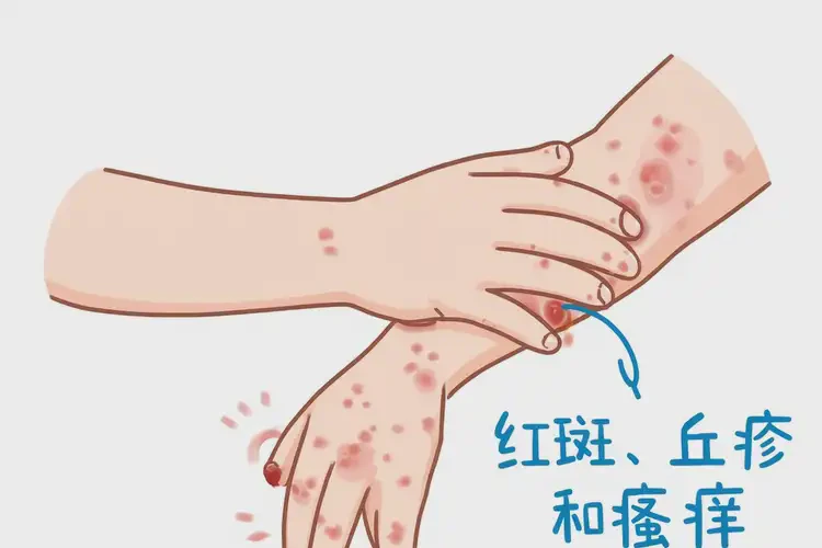 兒童全身容易長濕疹不管它會自己好嗎(圖4)