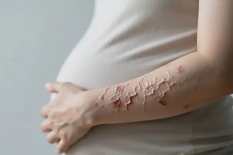 产妇全身长湿疹可不可以根治(图2)