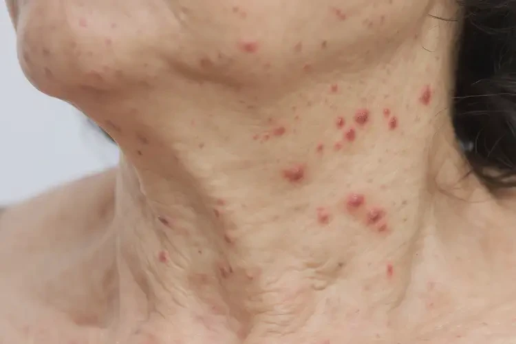 女人脖子上起濕疹能不能根治(圖4)