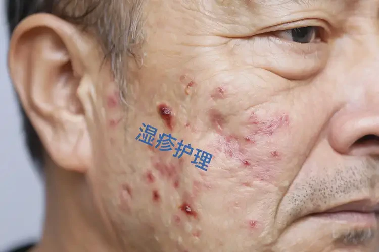 男人身上經(jīng)常起濕疹可不可以徹底自愈(圖4)