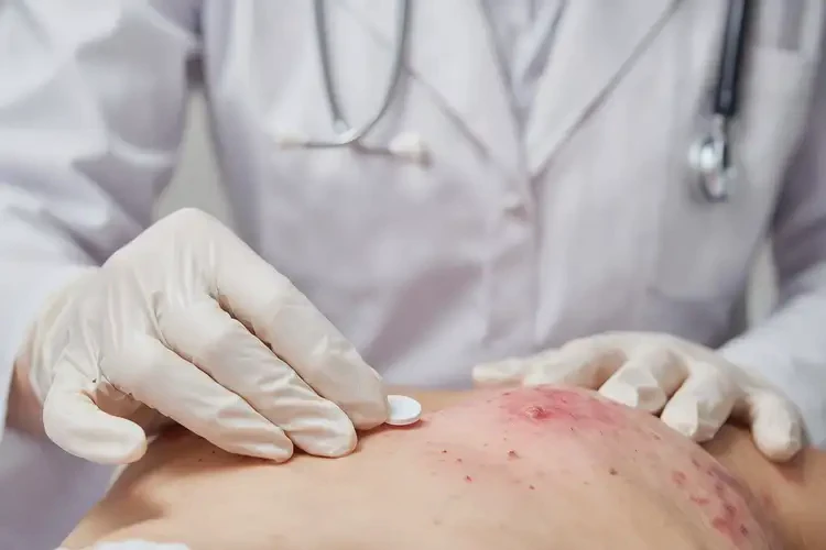 男生肛周有濕疹不管它會自己痊愈嗎(圖3)