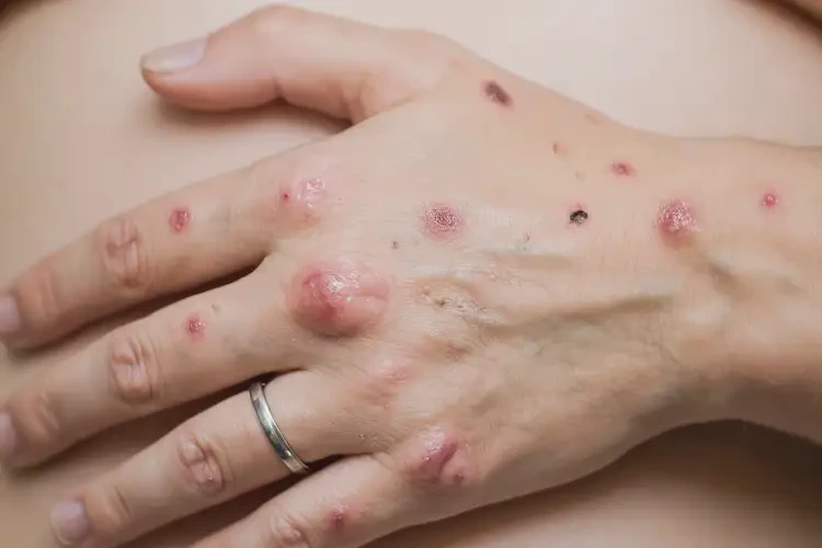 哺乳期媽媽手上起濕疹不管它會自己自愈嗎(圖4)