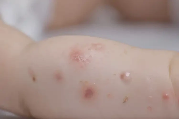 嬰幼兒手臂上有濕疹可不可以根治(圖4)