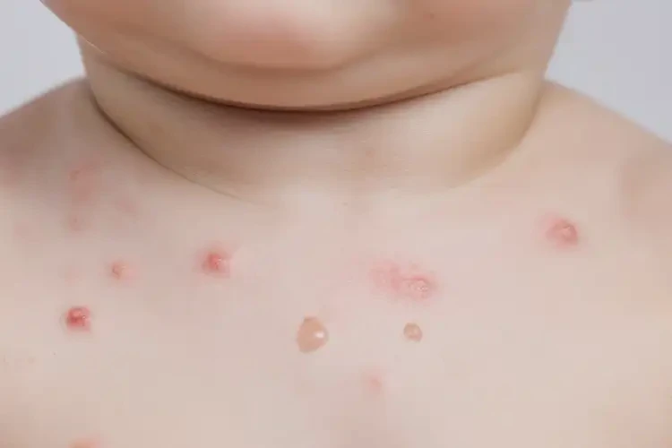 嬰幼兒脖子出現(xiàn)濕疹可不可以根治(圖4)