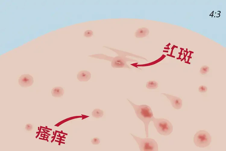 女生肛周起濕疹可不可以根治(圖4)