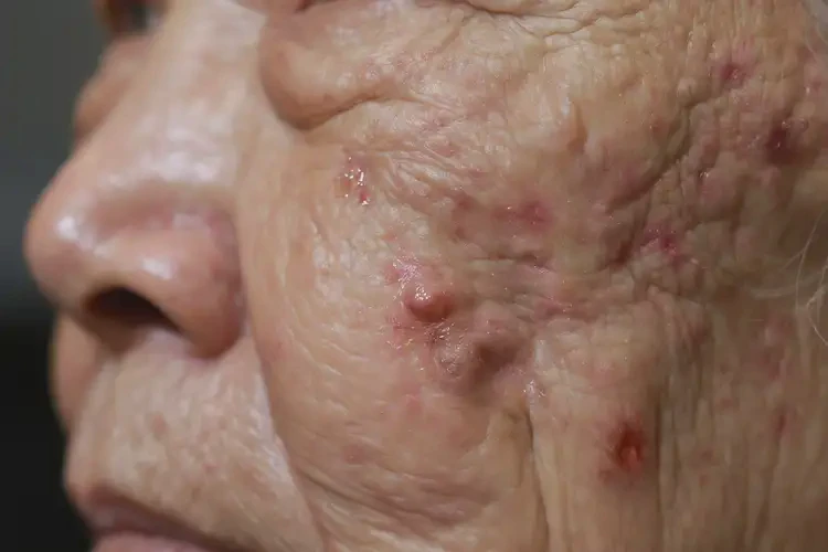 老年人脸上出湿疹可以彻底自愈吗(图4)