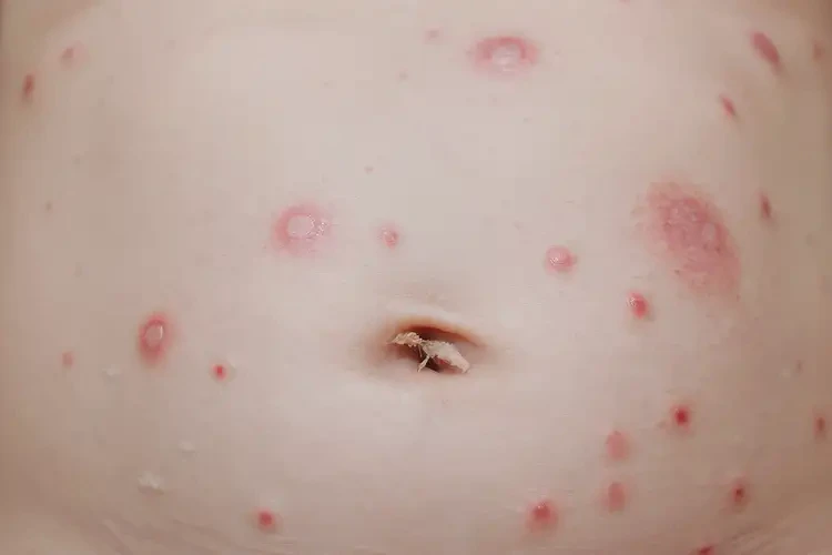 新生兒肚子上出濕疹不管它會自己自愈嗎(圖4)