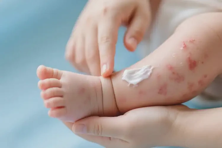 嬰兒小腿上經(jīng)常長濕疹可不可以根治(圖3)