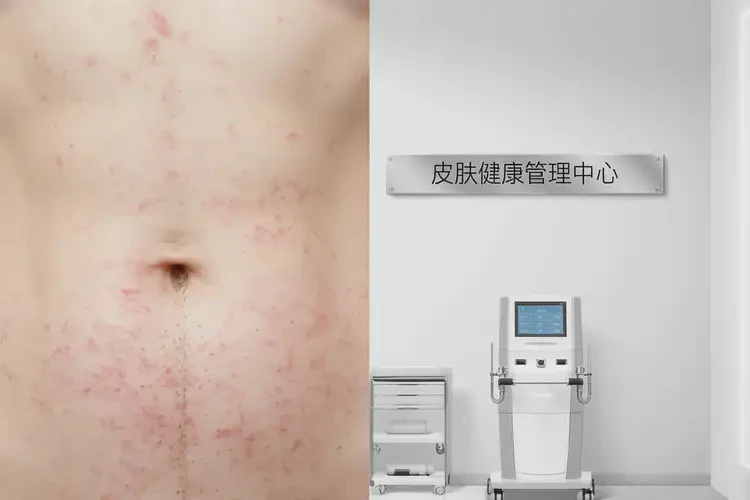 哺乳期媽媽肚子上出現(xiàn)濕疹能不能根治(圖3)