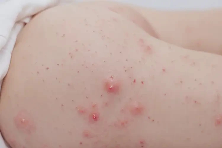 孩子肛周出濕疹可以徹底自愈嗎(圖4)