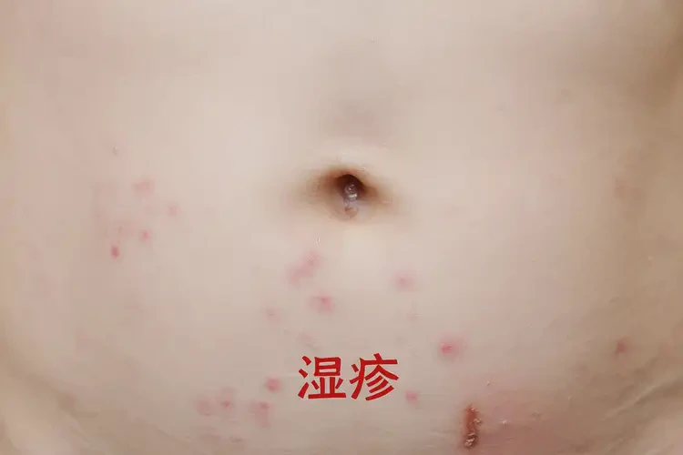 儿童肚子容易起湿疹能够彻底治愈吗(图4)