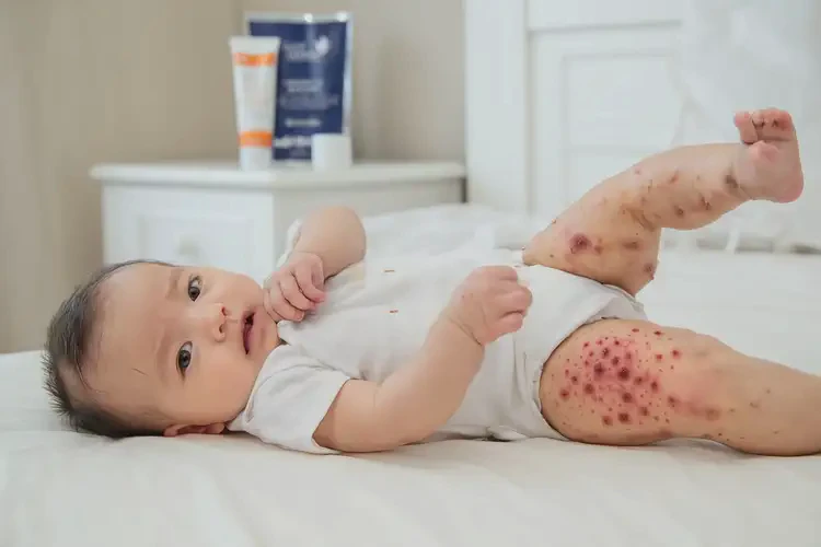 宝宝大腿起湿疹可不可以根治(图4)