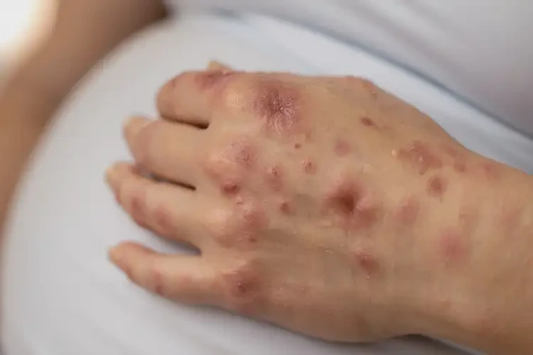 產(chǎn)婦手上長濕疹可不可以根治(圖4)