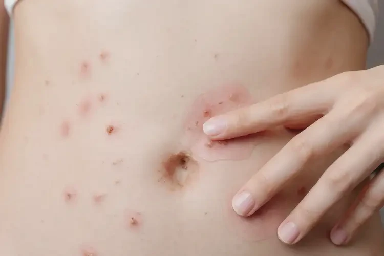 女生肚子上起濕疹不管它會(huì)自己自愈嗎(圖4)