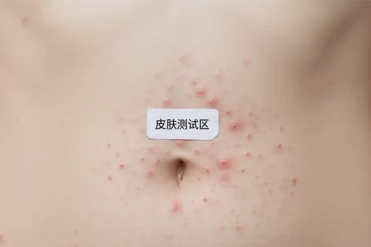 女生肚子上長濕疹能徹底自愈嗎(圖4)