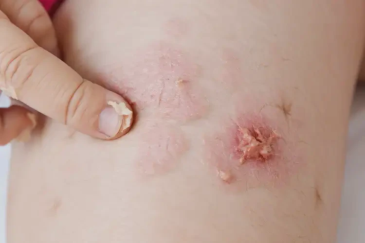 兒童大腿偶爾長(zhǎng)濕疹可不可以根治(圖4)