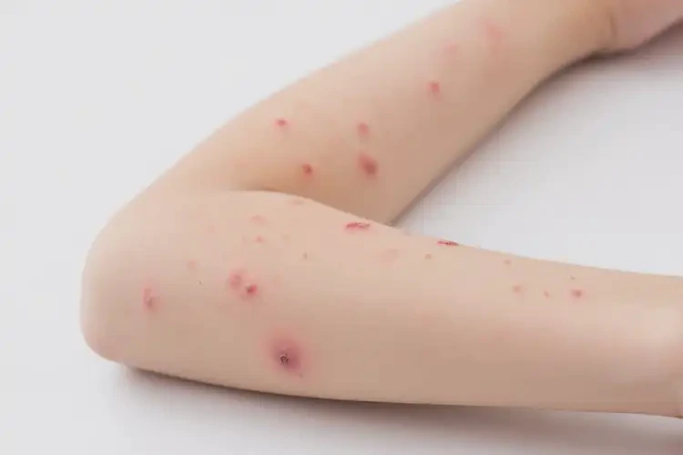 小孩手臂上起濕疹可以徹底自愈嗎(圖3)