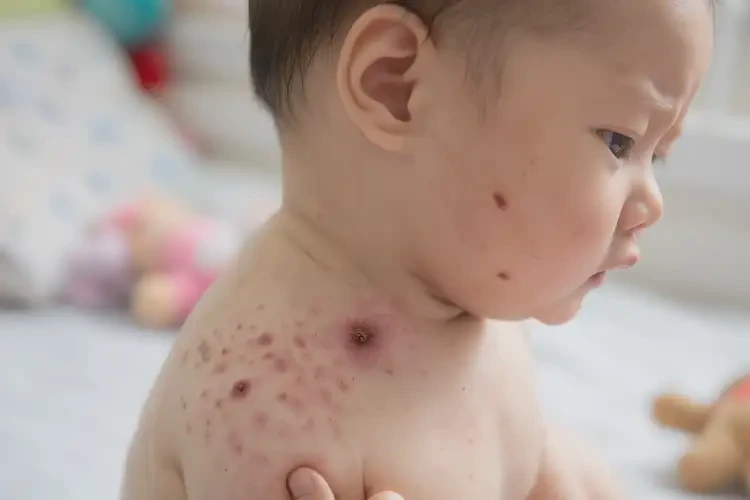 寶寶脖子長濕疹可不可以根治(圖4)