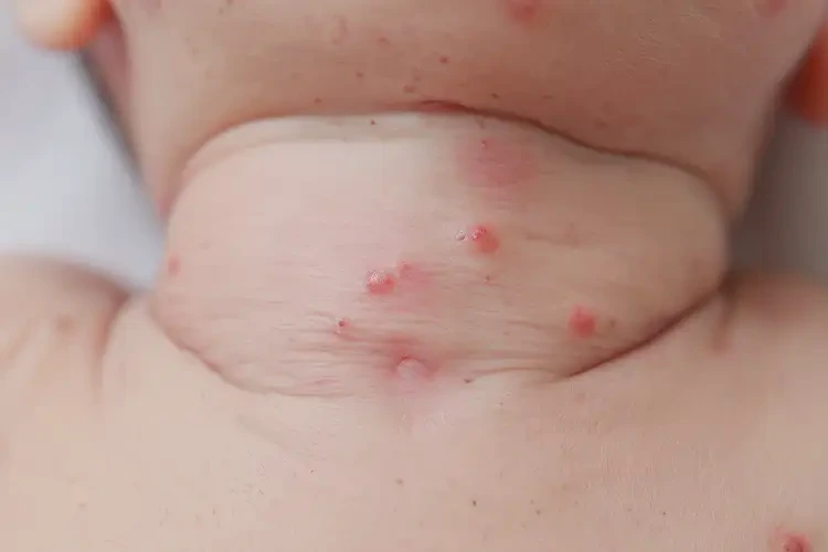 新生兒脖子偶爾長(zhǎng)濕疹可不可以根治(圖4)