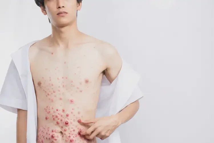 青年人肚子出現(xiàn)濕疹可以徹底自愈嗎(圖4)