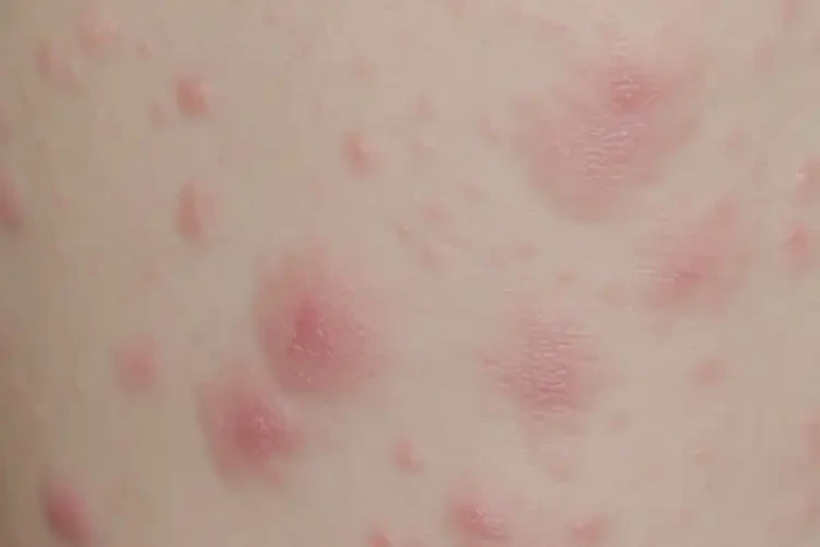 女生肚子長(zhǎng)濕疹可不可以根治(圖4)