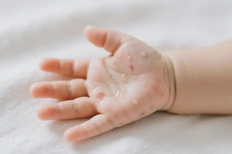 嬰兒手上偶爾長(zhǎng)濕疹可不可以根治(圖2)