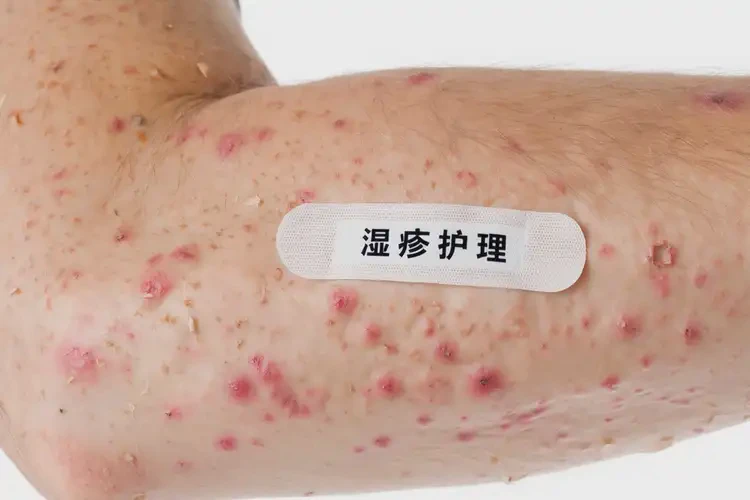 男性手臂上长湿疹可以彻底自愈吗(图3)