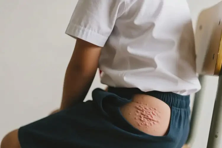 小學生屁股上起濕疹不管它會自己自愈嗎(圖3)