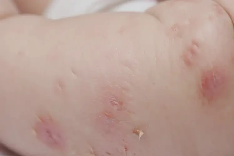 寶寶四肢經(jīng)常起濕疹可不可以徹底自愈(圖4)