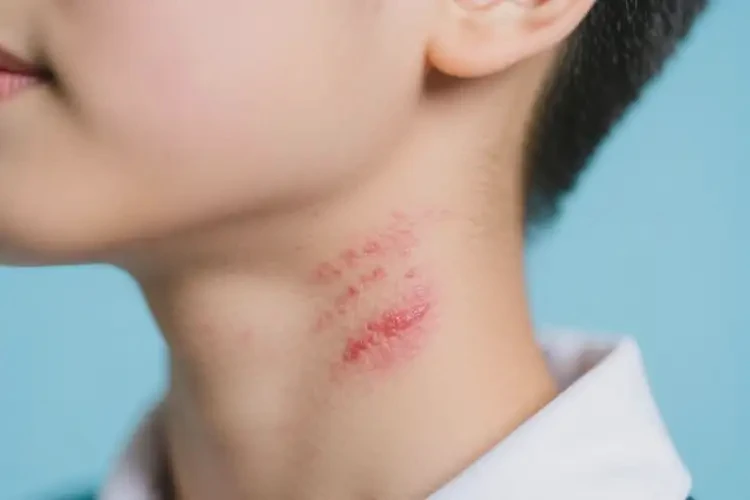 中學生脖子容易長濕疹能靠自己自愈嗎(圖4)
