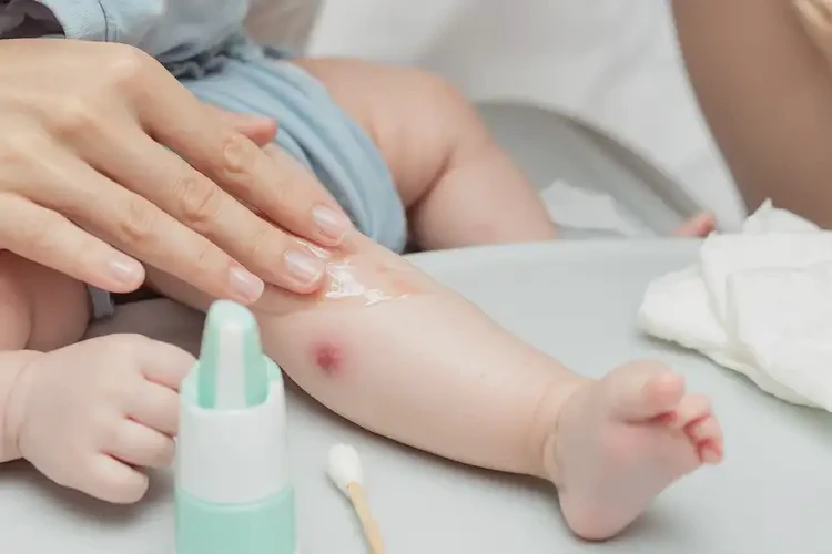 宝宝手臂有湿疹可不可以根治(图3)