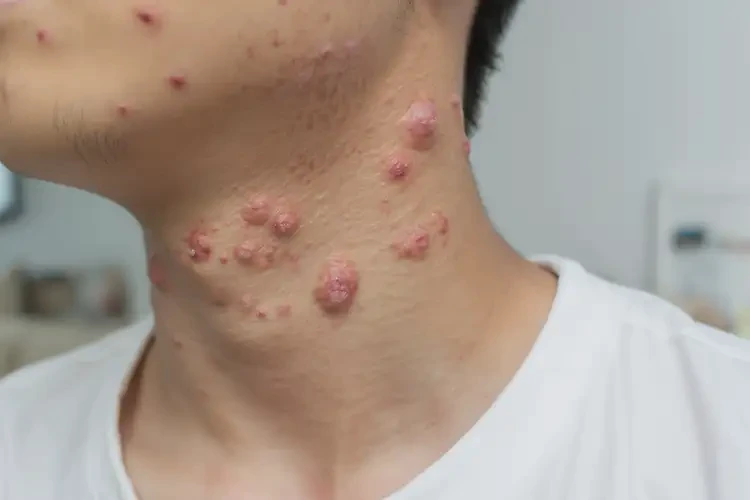 青少年脖子偶爾起濕疹可不可以根治(圖4)