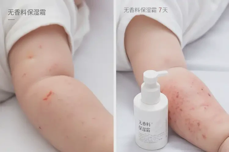 新生兒手臂上容易起濕疹可不可以根治(圖2)