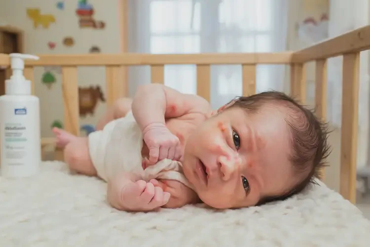 新生兒身上容易起濕疹不管它會(huì)自己自愈嗎(圖4)