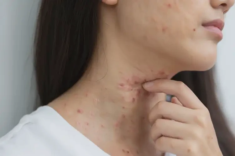 女性脖子偶爾長(zhǎng)濕疹能靠自己自愈嗎(圖3)