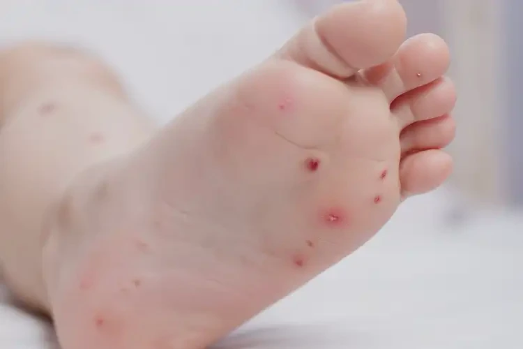 少兒腳上偶爾長濕疹不管它會(huì)自己自愈嗎(圖4)