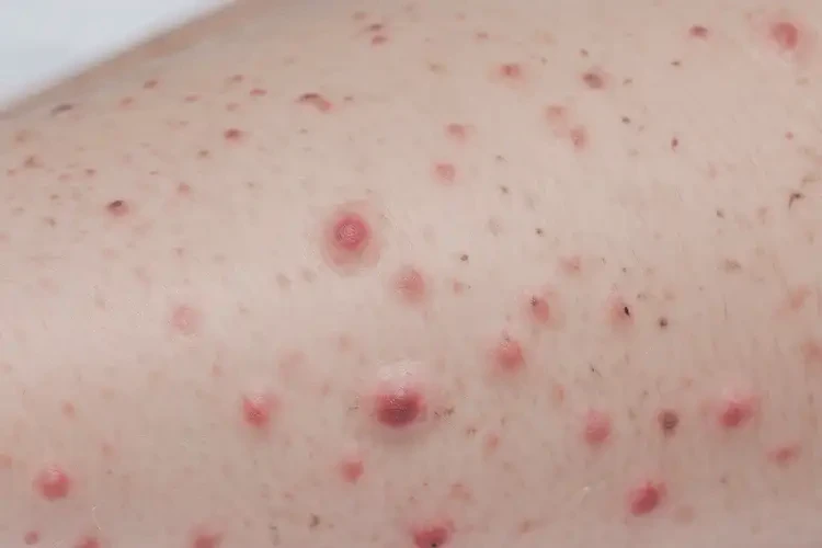 嬰幼兒大腿出濕疹可不可以根治(圖4)