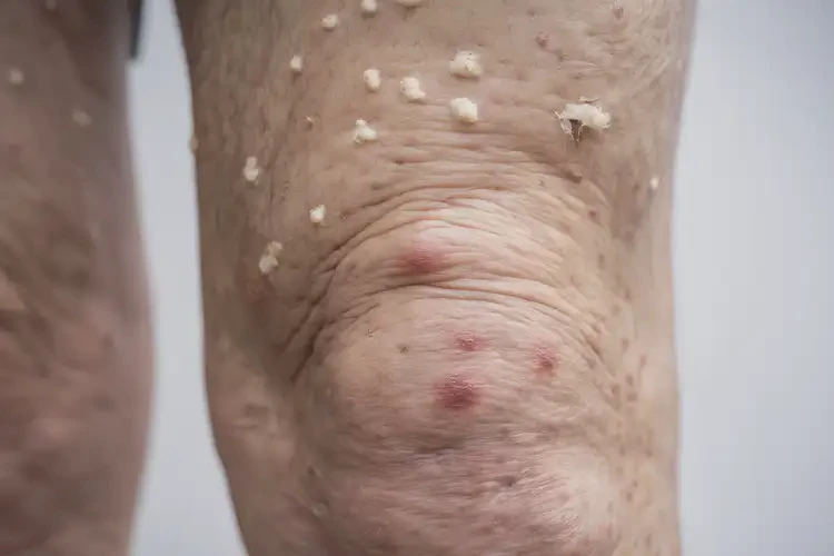 高齡老人大腿容易起濕疹能不能根治(圖4)
