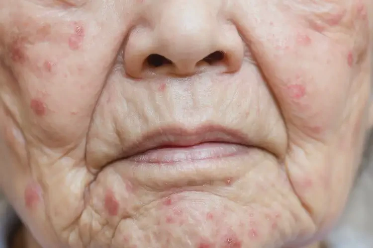 老年人臉上容易起濕疹可不可以徹底自愈(圖4)